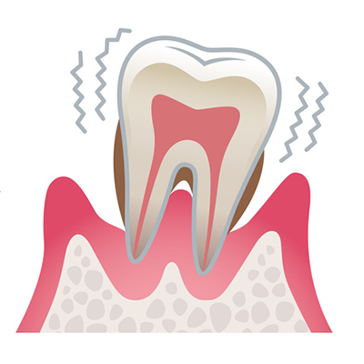 歯を失う最大の原因、歯周病